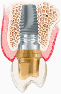 Teeth Implants: Advantages
