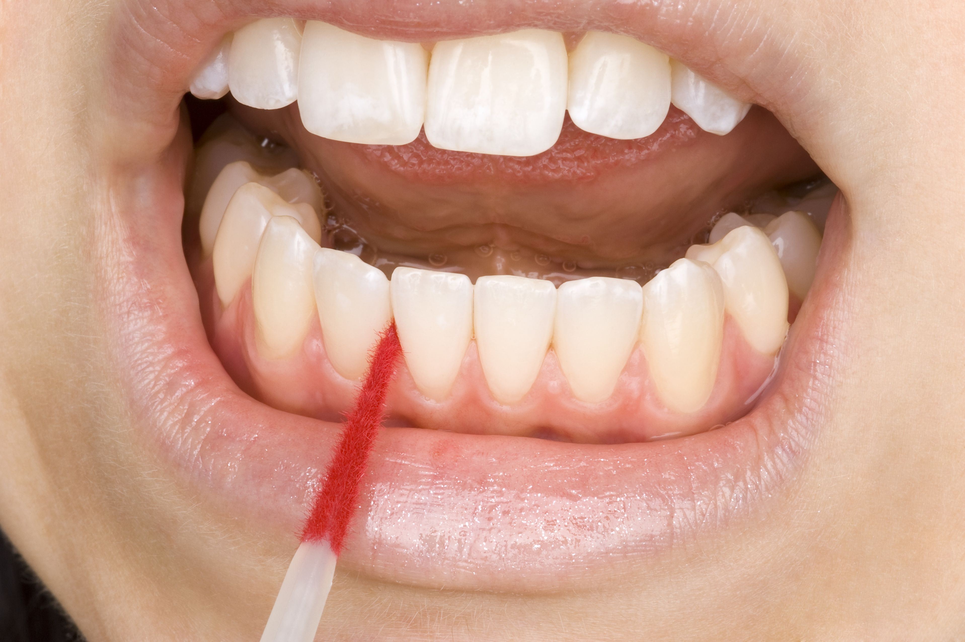 Teeth Whitening In Campbelltown: Many Benefits